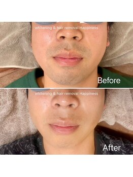 ハピネス 広島並木通り店(Happiness)/ヒゲ脱毛