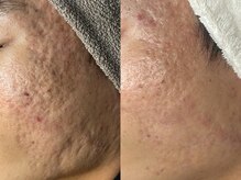 プレナ(PLENA)/凸凹ニキビケア！透明感&艶肌♪