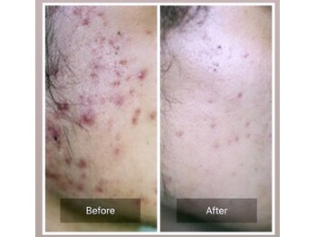 エミルカ 自由が丘店(EMILUCA)/頬の赤み、ニキビケア