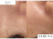 ルネア(LUNEA)/《症例》毛穴