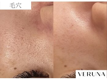 ルネア(LUNEA)/《症例》毛穴