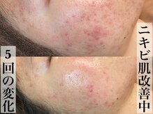 ビジュープラス 広島店(Bijou+)/【20代/ニキビ肌】