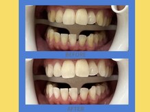 ココティ ホワイトニング(Cocotii)/お客様ビフォーアフター