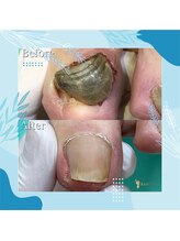 巻き爪補正店 秋葉原店/ 【分厚い爪/変形爪再生補正】