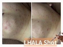 ラシック(La chic)/ララショット ニキビ/敏感肌ケア