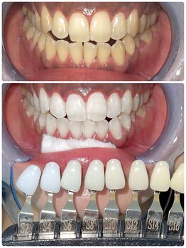 エクシアホワイトニング 札幌中島公園店/Before After［ホワイトニング］