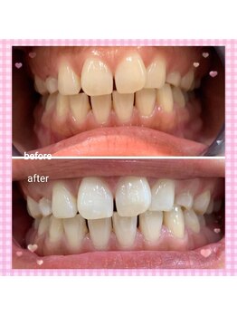 カシワビューティーココ(kashiwa beauty coco)/セルフホワイトニング