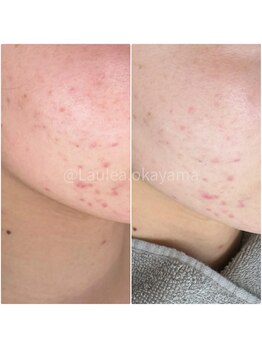 ラウレア(Laule'a)/ハーブトリートメント