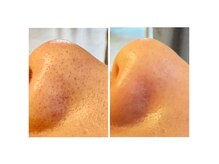 黒ずみ・いちご鼻・毛穴開きにはハイドラフェイシャル