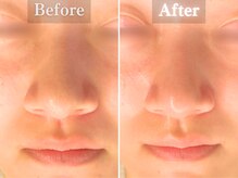 ボーンオム(Born Homme)/毛穴洗浄＋美容液導入：20代女性