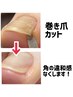 【巻き爪カット】足の巻いた爪/違和感なくしてさくさく歩く♪まずはお試し♪