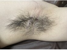 エステサロン桜/男性のわき毛も・・・