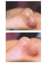 エステルーム チュラ 那覇上間店(Chura)/フェイシャル人気No1＊毛穴ケア