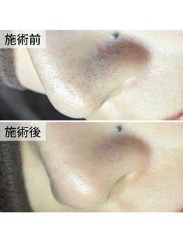 美鼻ラボ 押上 曳舟/黒ずみの正体は…?