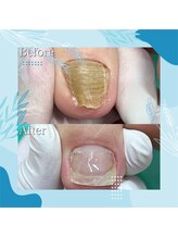 巻き爪補正店 秋葉原店/ 【分厚い爪/変形爪再生補正】