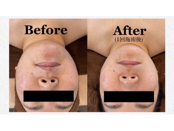 ベリンダ(BELINDA)/アキュライズ