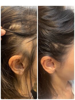 長寿鍼灸院 長寿整骨院/頭皮ケア/頭皮鍼100本