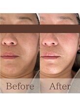 凪眠/小顔リンパフェイシャルの効果44