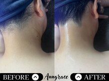 アングレイス(Anngrace)/【顔脱毛うなじ】Before/After