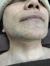 ブリッジ(BRIDGE)/メンズのヒゲ脱毛