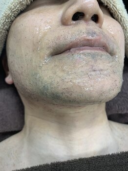 ブリッジ(BRIDGE)/メンズのヒゲ脱毛