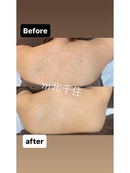 M 北千住店(/剥離あり!!お背中１回の施術後。