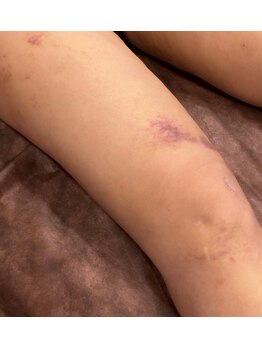 エステアンドヘアーサロン アルテ 札幌/術後すぐ!抜糸後はアルテ