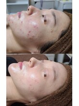 レイ(Lei) ニキビケア ピーリング