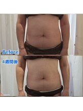 エステティック らぽーる(Rapport)/脂肪冷却痩身２カップ