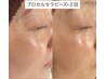 【毛穴/ニキビケア】プロセルセラピーズトリートメント ¥35,000