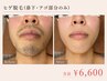 【男性限定】何回通っても同価格☆ヒゲ脱毛￥6,600