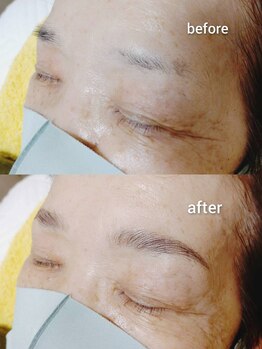 マツ(MATSU)/【ハリウッドブロウリフト】