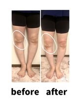 カイロプラクティック コダマ(KODAMA)/美脚ビフォーアフター
