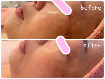 ヒメミ(Himemi)/BBL光エステ