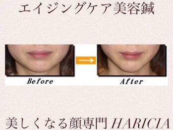 ハリシア(HARICIA)/たるみの改善