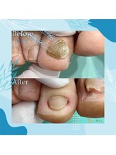 巻き爪補正店 秋葉原店/ 【分厚い爪/変形爪再生補正】