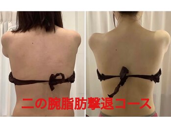 ビジュラン グロスキングツヤ王(Bijuran GlossKingツヤ王)/二の腕肩こり脂肪撃退４回の変化