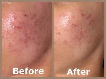 スイ 昭島店(Sui)/ハーブピーリング/ニキビケア