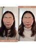 春までに間に合う【短期集中結果出し】美容鍼灸フェイシャルエステ４回　