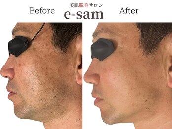 イーサム(e-sam)/髭脱毛