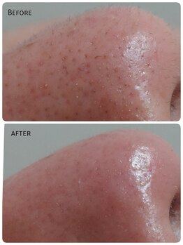 キナリ(kinari)/鼻もワックス脱毛で綺麗に♪