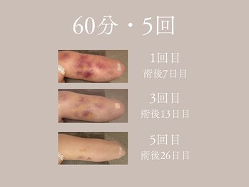 ハネ 自由が丘(Hane)/[自由が丘/インディバ/術後ケア]