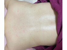 エステサロン ジジ 新宿(JIJI)/プラズマ背中ケアを1回