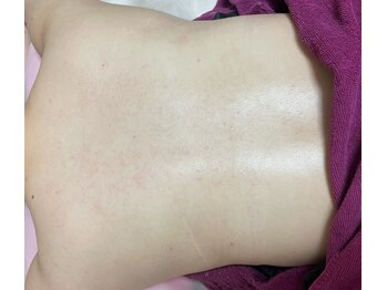 エステサロン ジジ 新宿(JIJI)/プラズマ背中ケアを1回