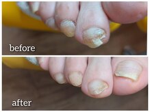 爪切り屋 足楽/割れる足爪
