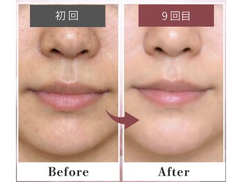 フルリール/【超音波毛穴洗浄＆全顔脱毛】