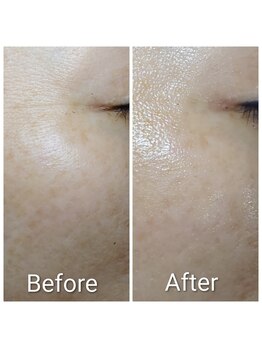 凛美庵/目元の小じわ改善 Before→After