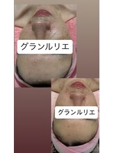 グランルリエ(Gran Rurier)/毛穴、ニキビ、小顔、鼻矯正