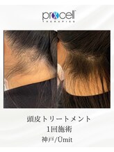ユミト(Umit)/プロセルスカルプ