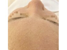 ゴールド 栄店(GOLD)/【1】浮き上がってきた皮脂汚れ